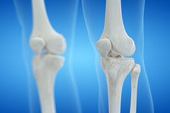 Orthopädie Knie | Klinik für Orthopädie Siegen
