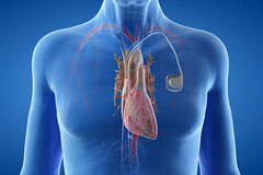 Herz-Schrittmacher | Kardiologie Siegen